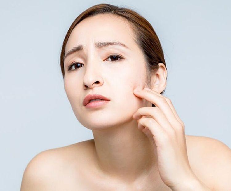 Mụn ẩn ở má: Nguyên nhân và cách điều trị hiệu quả nhất